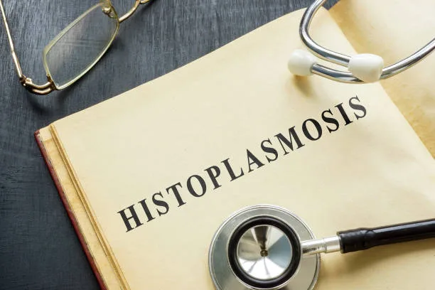 Histoplasmosis in Pakistan: Understanding the Fungal Infection