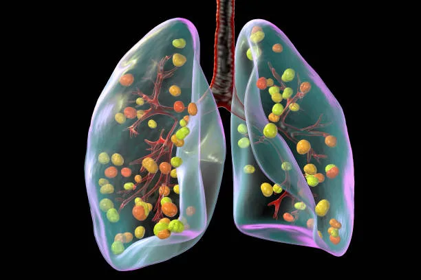 Histoplasmosis in Pakistan: Understanding the Fungal Infection