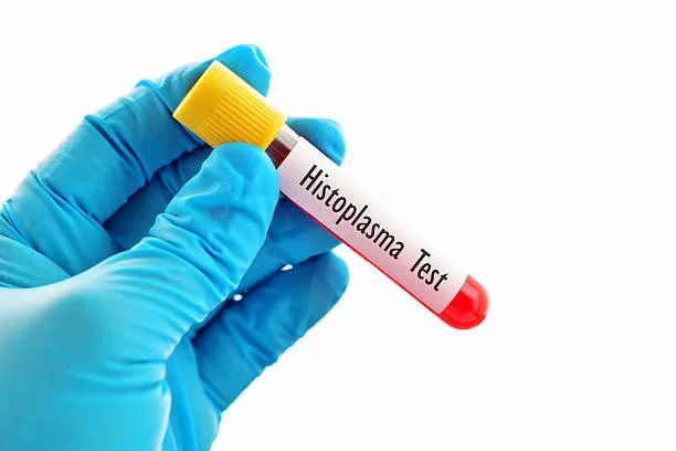 Histoplasmosis in Pakistan: Understanding the Fungal Infection