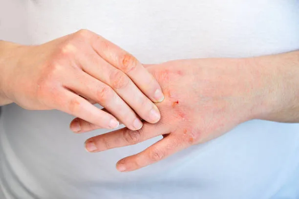 Why do Skin allergies occur in winter